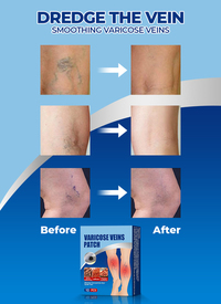 Varicose Veins Patch